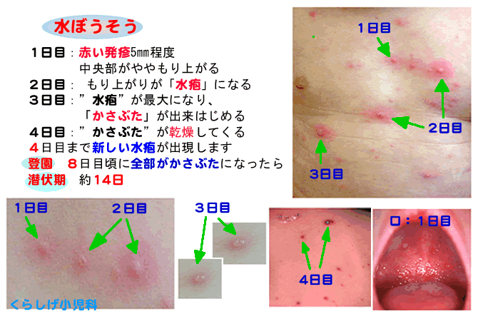 初期 症状 水疱瘡