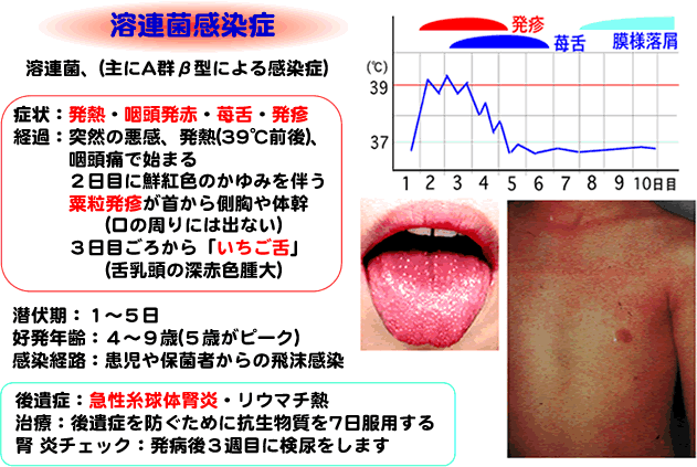 溶連菌 感染 経路