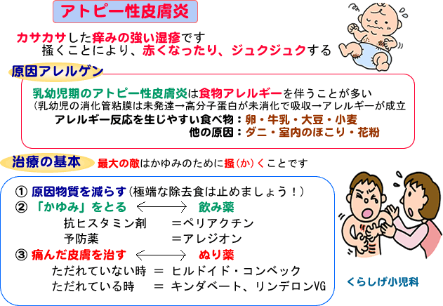 リンデロン とびひ とびひ等で使用される「リンデロンvg」の成分って？